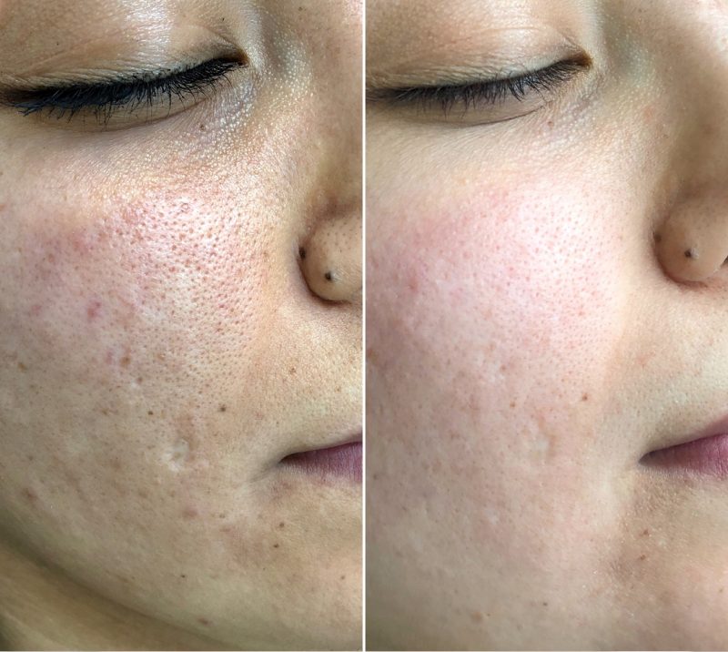 BeautyLab microneedling