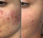 BeautyLab microneedling