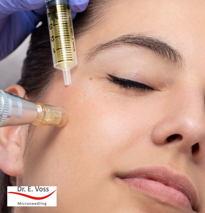 BeautyLab microneedling